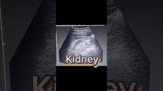 Small Kidney  cortical Thinning  Renal parenchymal Disease on Ultrasound [upl. by Narud27]