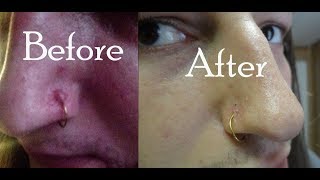 How to Get Rid of a Keloid in a week [upl. by Llenoil]