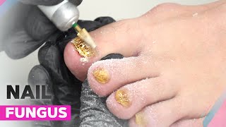 Onychomycosis  How to Deal with Nail Fungus [upl. by Iahk]