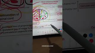 Brown Sequard Syndrome  Neurology inicet neetpg fmge [upl. by Ledba]