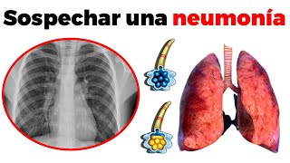 Síntomas de NEUMONÍA cómo se diagnostica y tratamiento [upl. by Nyladnewg629]