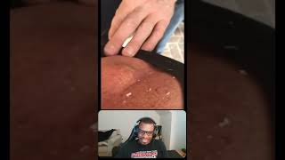 Gushing Back Cyst Pop pimple pimplepop blackhead whitehead shorts [upl. by Yehs]