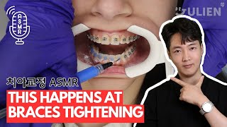 ASMR  This is What Braces Tightening Looks Like [upl. by Clementi]