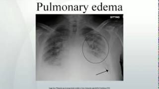 Pulmonary edema [upl. by Lipp]