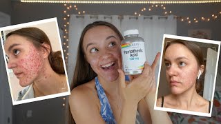 I TOOK PANTOTHENIC ACID FOR 2 MONTHS  Pantothenic Acid B5 For Acne [upl. by Adlay]