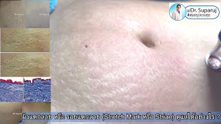 📍ผิวแตกลาย หรือ รอยแตกลาย Stretch Mark หรือ Striae ดูแลได้อย่างไร หมอรุจชวนคุย รักษารอยแตกลาย [upl. by Llerihs]