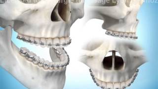 Chirurgie orthognatique ostéotomie maxillaire [upl. by Cullie]