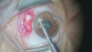 Pterygium surgery  Fibrin Glue [upl. by Einiar]