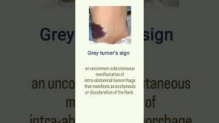 Difference between Grey Turners Sign and cullens Sign  ESIC  RRB  AIIMS anotomyandphysiology [upl. by Sherborn701]