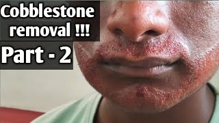 How to cure cobblestones cobblestone removal part 2  tamil [upl. by Aitram]