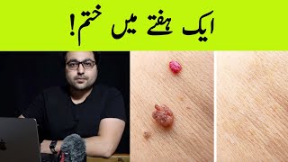 Dr ZeeHow to Rid Skin Tags and Warts  Quick fix  त्वचा के तिल [upl. by Cordelie]