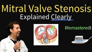 Mitral Valve Stenosis Diagnosis Treatment Pathophysiology [upl. by Adaval]