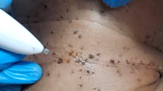 Removal of warts and skintags [upl. by Trebmer]