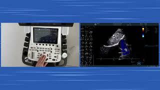 〖Echokardiografie〗 Subcostale Schnitte Handson  LV RV RVOT AK TK IVC SVC amp das Perikard 💫🫀 [upl. by Giguere]