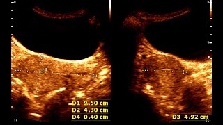 CERVICITIS  pelvic pain vaginal discharge and abnormal bleeding [upl. by Beaulieu]