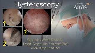 ASHERMAN Postseptum correction PRP application [upl. by Enaywd]