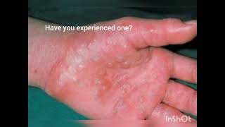 What is dyshidrotic eczema [upl. by Higgins800]