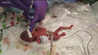 World’s smallest surviving baby born in San Diego [upl. by Benson152]