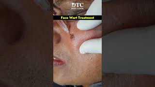 Removing Face Warts Safely and Effectively Treatment Options at DTC Skin Clinic [upl. by Esya]