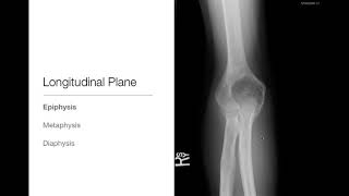 Bone Tumors  Location  Basic Radiology [upl. by Savell436]