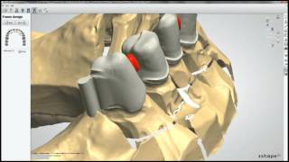 Attachment Crown im 3shape DentalSystem 2012  powered by WIELAND [upl. by Aisauqal]