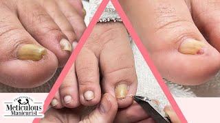 Ingrown Toenail Pedicure [upl. by Oppen323]