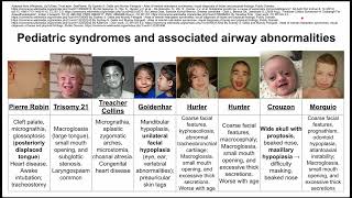 Pediatric syndromes and associated airway abnormalities [upl. by Hayikat]