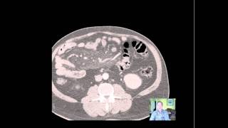 Sclerosing Mesenteritis CTmp4 [upl. by Yeorgi]