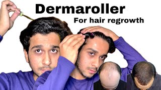 Using Dermaroller for hair regrowth [upl. by Yrrol967]