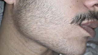 Minoxidil beard journey  The first shaving beard [upl. by Irwin]