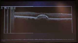 aioc2022 FP1942 Hyde Park V topic A UNIQUE CASE OF ADULT ONSET FOVEAL VITELLIFORM DYSTROPHY WITH D [upl. by Marius]