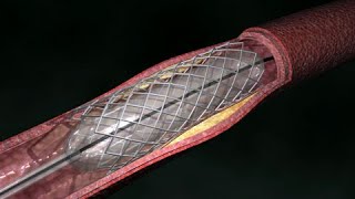 Angioplastia de arteria coronaria Vía radial [upl. by Gershon]