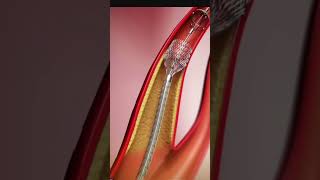 ANGIOPLASTY PROCEDURE ANIMATED [upl. by Acsicnarf329]