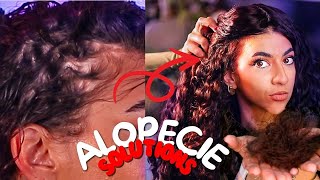 ALOPECIE LES SOLUTIONS NATURELLES [upl. by Anadal932]