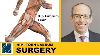 Hip Pain  Torn Labrum Hip [upl. by Leavy]