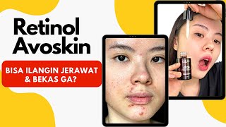 Review Retinol Avoskin Setelah Pakai 3 Bulan Beneran Hilangin Jerawat amp Bekas Ga [upl. by Dareg319]