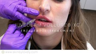 Juvederm Vollure  Lip Enhancement Demo  Skin by Lovely [upl. by Dorahs]