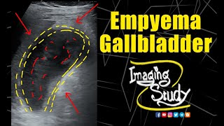 Empyema Gallbladder  Ultrasound  Case 322 [upl. by Kcirdor]