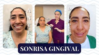 SONRISA GINGIVAL BÓTOX para dejar de mostrar las ENCÍAS al SONREÍR I MARISOL GÓNGORA [upl. by Bello]