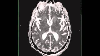 Cryptococcal meningitis [upl. by Ellehcem]