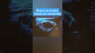 BIOPSIA DE TIROIDES GUIADA PPR ULTRASONIDO [upl. by Jose957]