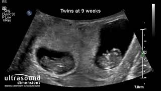 Scan of the Week Twins at 9 weeks gestation [upl. by Elleinahc]