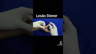 Lesão de Stener  Ruptura do Ligamento Colateral Ulnar [upl. by Kwabena]