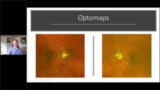 Using the RETeval ERG for Glaucoma w Dr Mike Cymbor OD [upl. by Ammann]