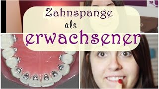 Zahnspange bei erwachsenen  Lingualtechnik  Kosten  JuMarie [upl. by Patsy913]