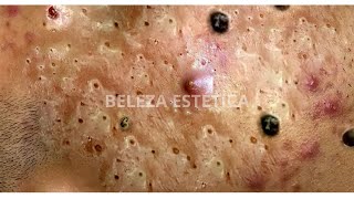 Como Remover Cravos e Espinhas do Rosto com Agulha 001 [upl. by Yenaffit]