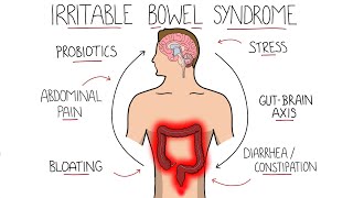 Irritable Bowel Syndrome IBS  Including Symptoms Criteria amp Treatment [upl. by Sonny]