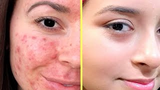 Get Rid of Acne Pimples amp Acne Spots amp Get Clear Skin at Home Urdu Hindi [upl. by Hana]