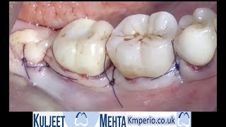 Periodontal surgery Lower right molars [upl. by Airel]