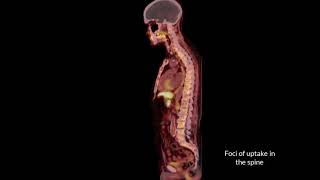 Osseous Metastatic Prostate Cancer  PETCT Scan  Charter Radiology [upl. by Findley]